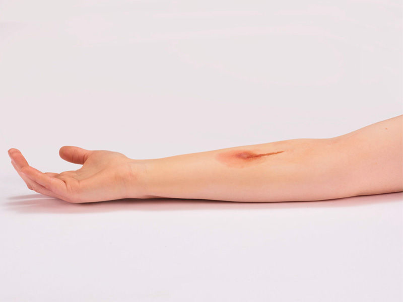 Outstretched right arm with elongated reddening of the skin below the elbow.