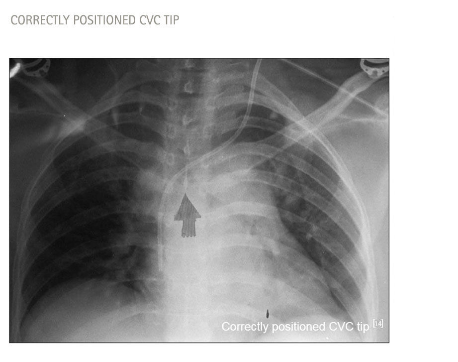 A fluorography image of the thorax showing the tip of a central venous catheter (CVC)
