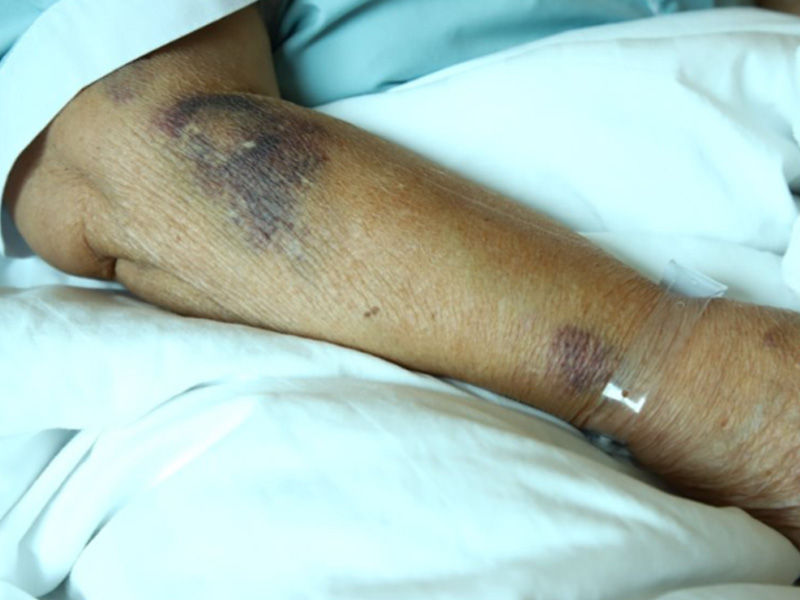 Right arm with several bruises below the elbow is lying on the bedspread.