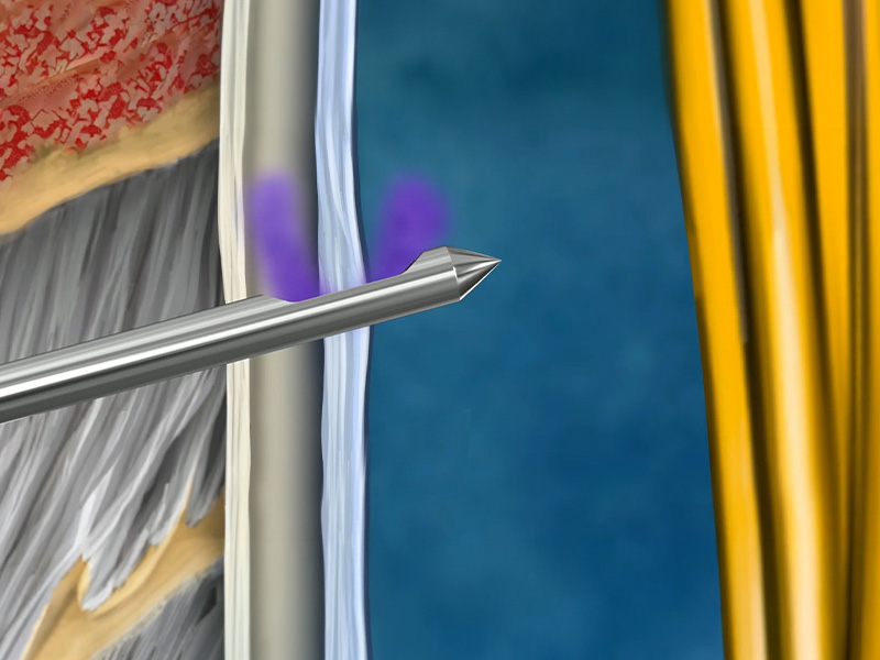 A spinal needle tip positioned near tissue layers, showing anatomical structures in cross-section with colored regions for muscle, dura, and nerve bundle